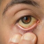 Potential Complications Arising from Jaundice and How to Manage Them