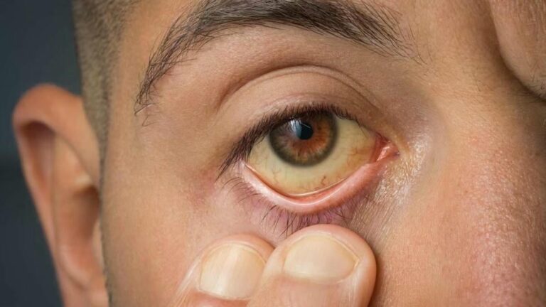 Potential Complications Arising from Jaundice and How to Manage Them